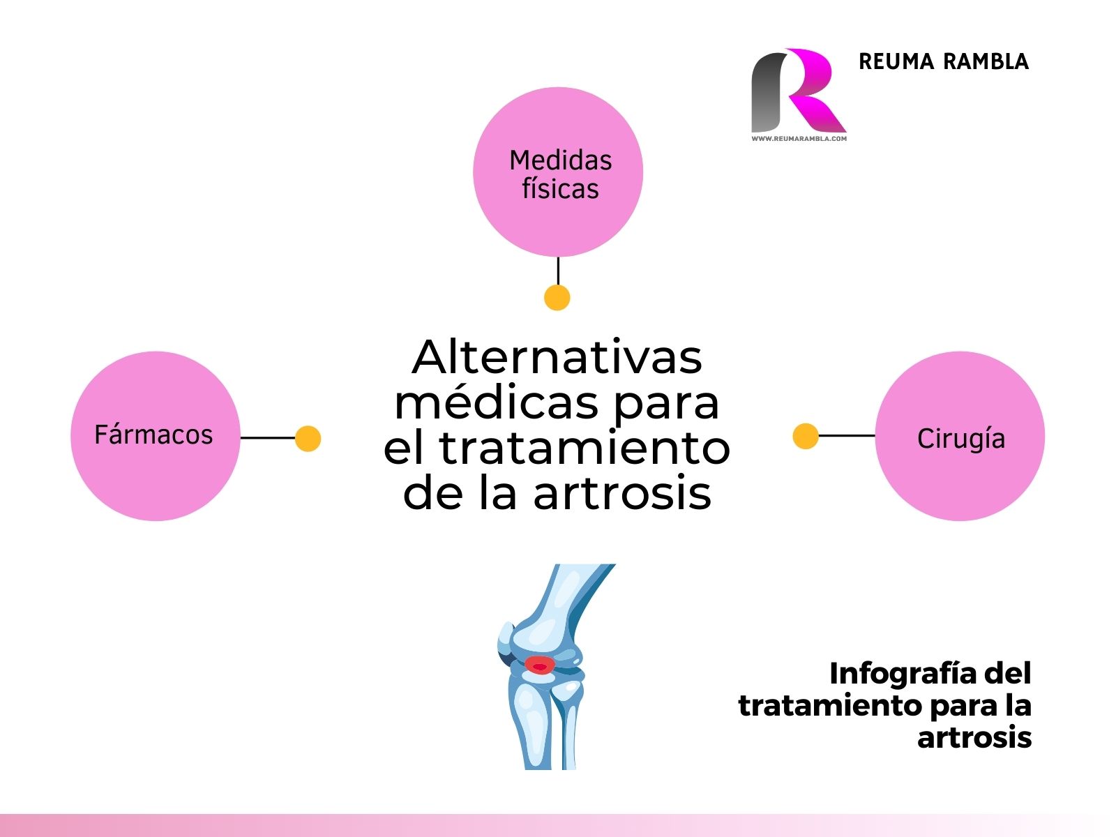 Tratamiento para la artrosis. Infografía.